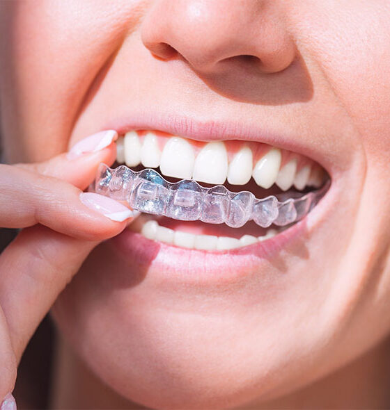 invisalign